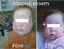 atopisk eksem bild