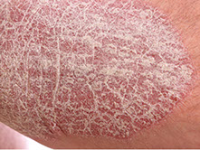 plackpsoriasis vanligaste typen av psoriasis